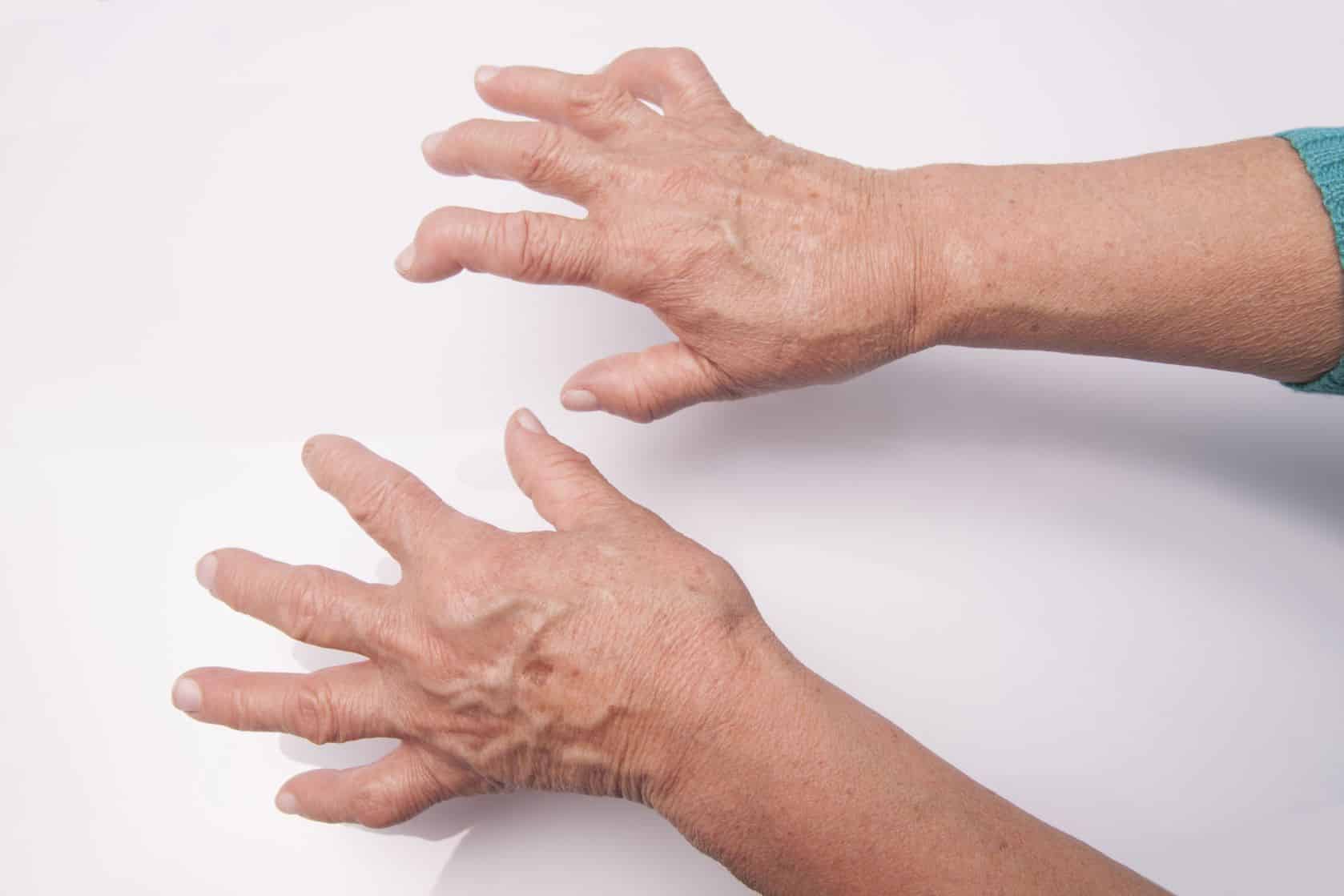 Ревматоидный артрит руки